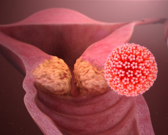 HPV инфекция и рак на маточната шийка