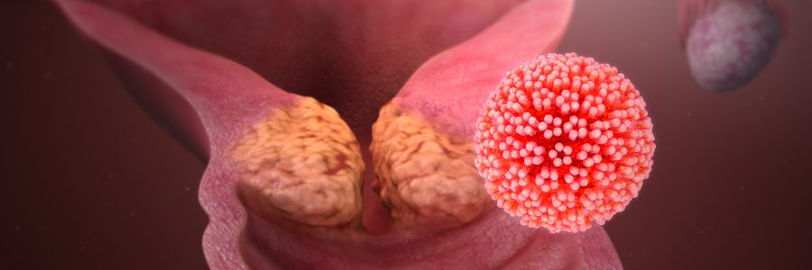 HPV инфекция и рак на маточната шийка